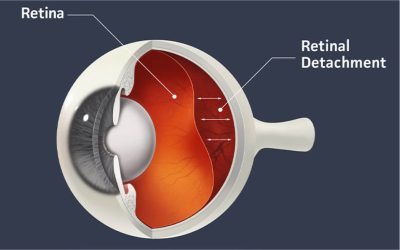 Ablasio Retina: Definisi, Penyebab, Gejala, dan Pengobatan