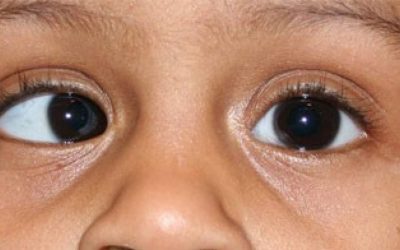 Mata Juling (Strabismus)