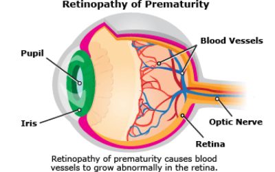 Retinopathy of Prematurity: Definisi, Gejala, Faktor Risiko, dan Pengobatan