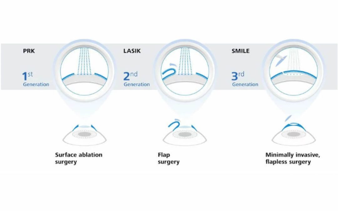 Teknologi Laser Vision Correction (LVC) Bebaskan Mata Minus dan Silinder