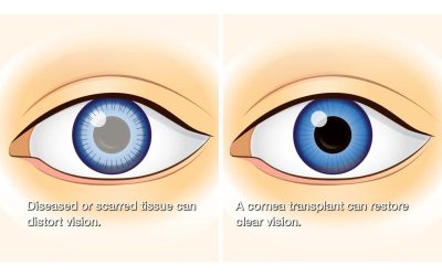 Transplantasi Kornea (Keratoplasty)