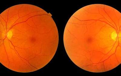 5 Penyebab Kerusakan Retina yang Perlu Diwaspadai
