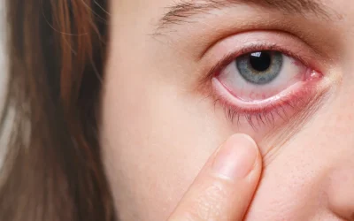 Konjungtivitis: Penyebab, Gejala, dan Cara Pengobatan